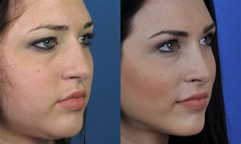 What Not To Do After Rhinoplasty